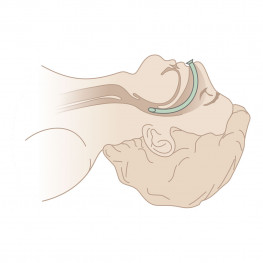 Nasopharyngeal Airway