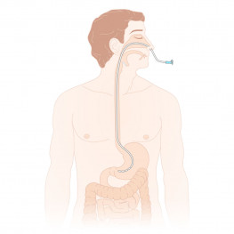 Feeding tube