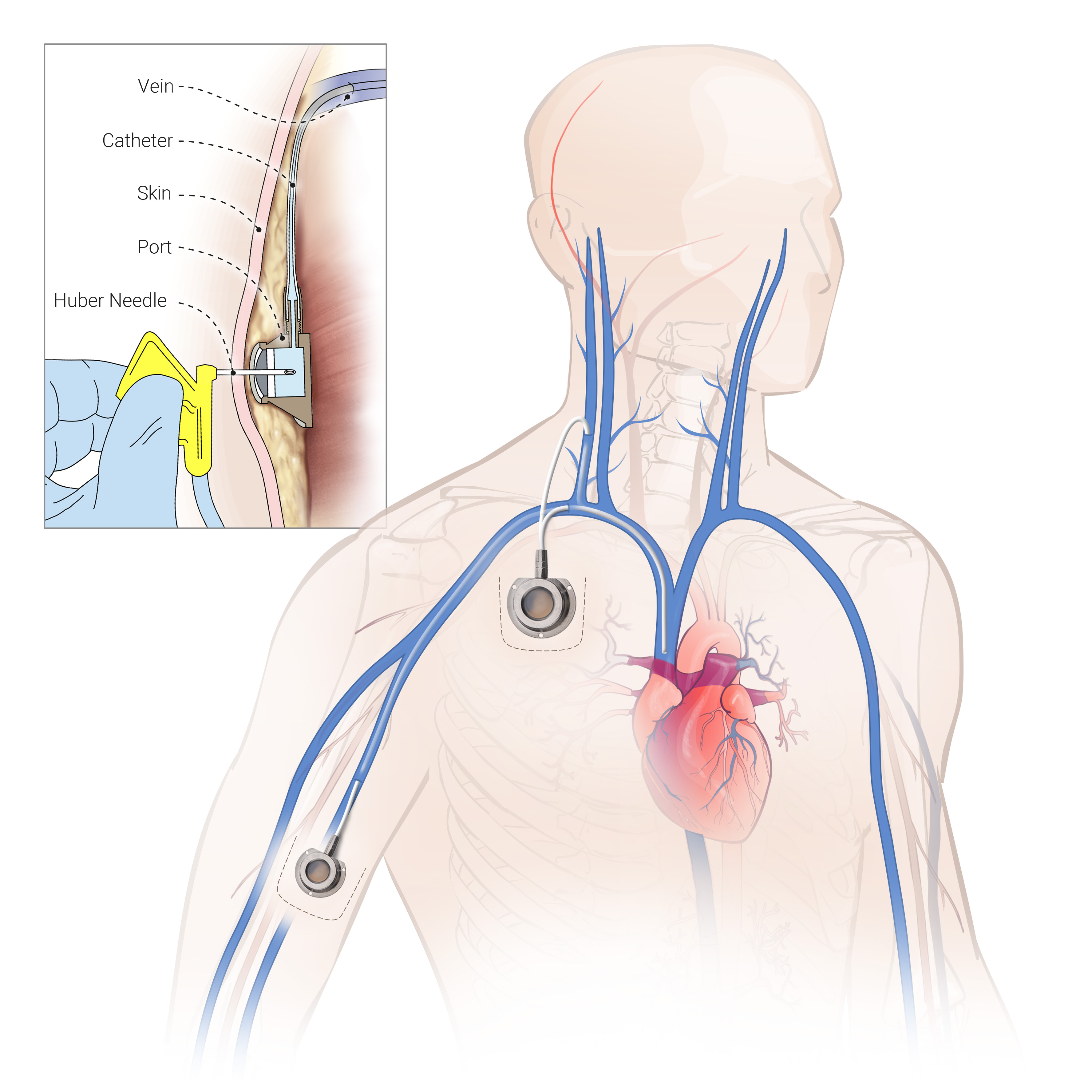 Implantable Port system placement