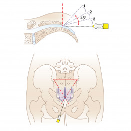 Caudal needles