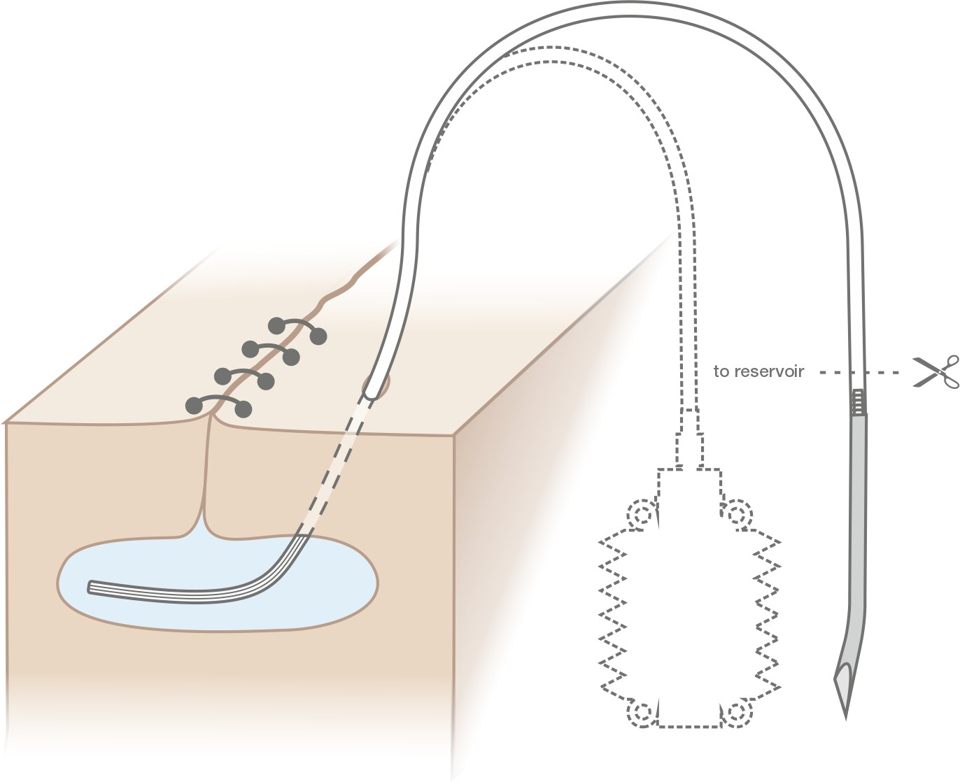 Wound Drainage Set with SIlicone Reservoir and Silicone Round Fluted Drainage Tube